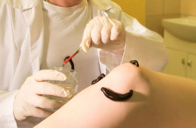 Hirudoterapia para varices