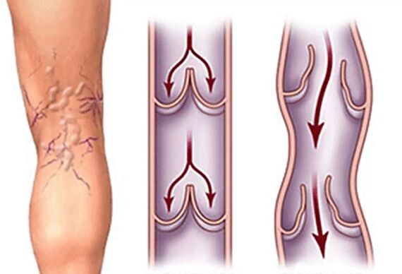 Vea normal e varices