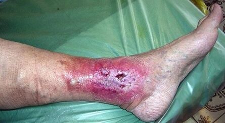Complicacións para varices