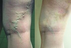 Varices nas pernas