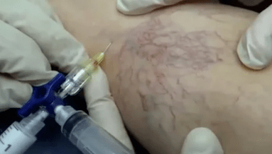 escleroterapia para varices