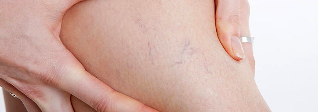 Arañas con varices