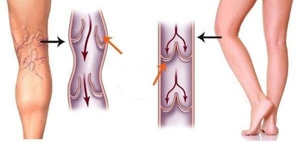 veas saudables e varices