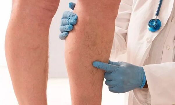 O médico examina as pernas en busca de varices